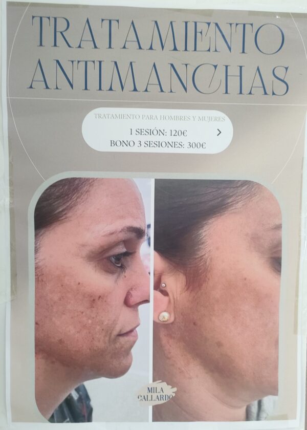 Tratamiento anti manchas